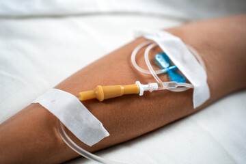 Close-up of an Intravenous IV Line in an Arm
