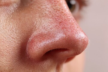 Obraz premium Skin Cancer Face. Cryosurgery Treatment for Sun Spots on Nose with Crusty Skin