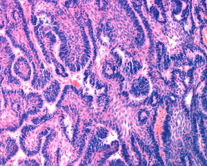 Ameloblastoma