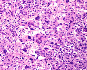 Human lung. Anaplastic epidermoid carcinoma