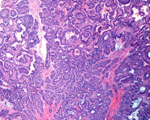 Ameloblastoma