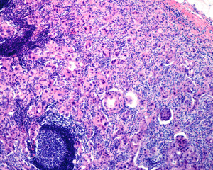 Lymph node. Breast carcinoma metastasis