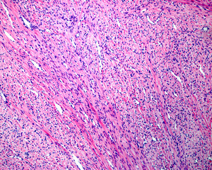 Uterine fibroid