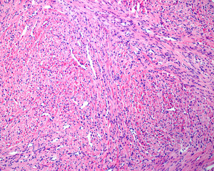 Uterine fibroid
