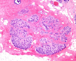 Breast fibrosis