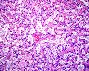 Human ovary. Papillary carcinoma