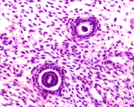 Endometrial glands. Telescoping