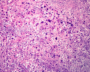 Human lung. Anaplastic epidermoid carcinoma