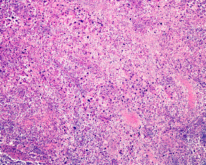 Human lung. Anaplastic epidermoid carcinoma