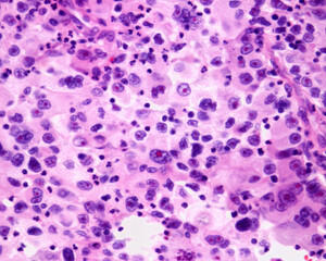 Cancerous anaplastic cells