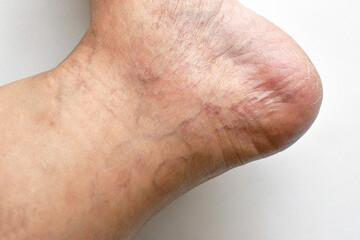Fototapeta premium Varicose veins on woman heel and foot. Healthcare and medical concept.