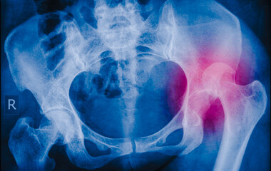 hip dislocation , x ray image 
