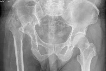 hip dislocation , x ray image 
