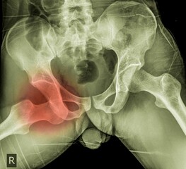 hip dislocation , x ray image 
