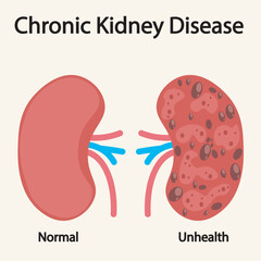 Chronic kidney disease vector illustration showing key symptoms like fatigue, swelling, nausea, and related conditions such as diabetes and hypertension.