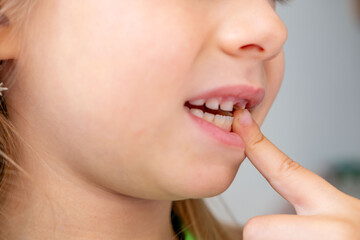 Happy girl showing missing tooth, smiling child, baby tooth fell out, childhood moment waiting for...