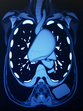 CT scan show heterogeneous mass at interior mediastinum , the mass slightly invade proximal lower part of svc for medical and technology concepts