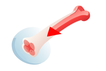 Illustration of a bone with a red arrow indicating stress or pressure on a joint