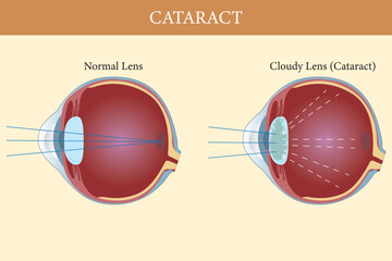 Medical illustration comparing normal eye lens and cloudy lens affected by cataract.
