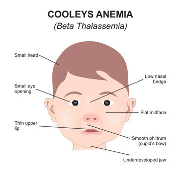 Cooleys Anemia (Beta Thalassemia) Illustration
