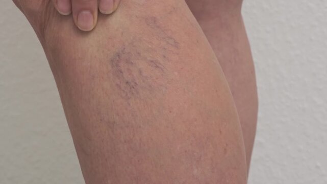 Varicose veins on women's legs. Close-ups of spider veins, dilated capillaries on a woman's shin that can be removed by sclerotherapy, reticular veins. Stage one. Phlebology.