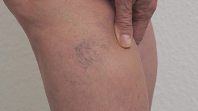 Varicose veins on women's legs. Close-ups of spider veins, dilated capillaries on a woman's shin that can be removed by sclerotherapy, reticular veins. Stage one. Phlebology.