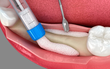 Bone grafting augmentation for tooth implantation. Medically accurate 3D illustration.