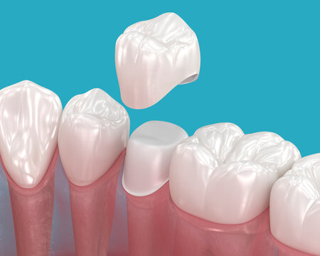 Dental crown placement over tooth. 3D illustration