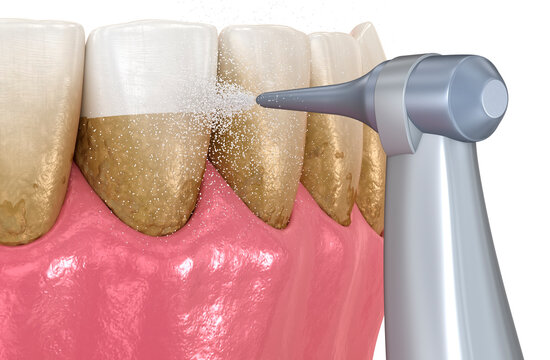 Oral hygiene: Air flow teeth cleaning process. Dental 3D illustration