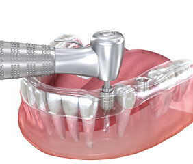 Surgical guide for implantation procedure. Dental 3D illustration.