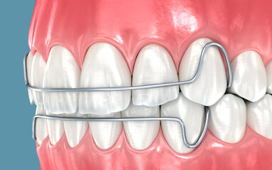 Dental retainers installed after braces treatment, 3D illustration