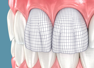 Digital dentistry, veneer planning. Dental 3D illustration