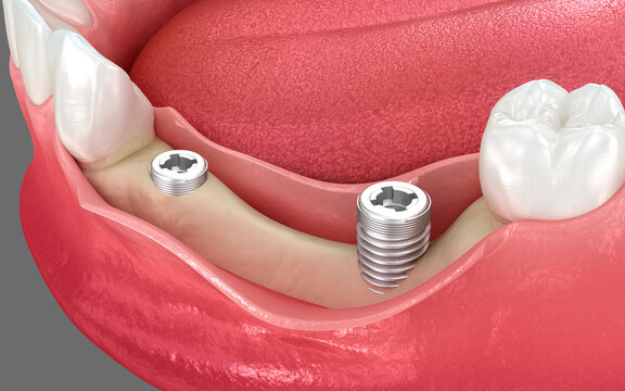 Dental implants and bone lost. 3D illustration
