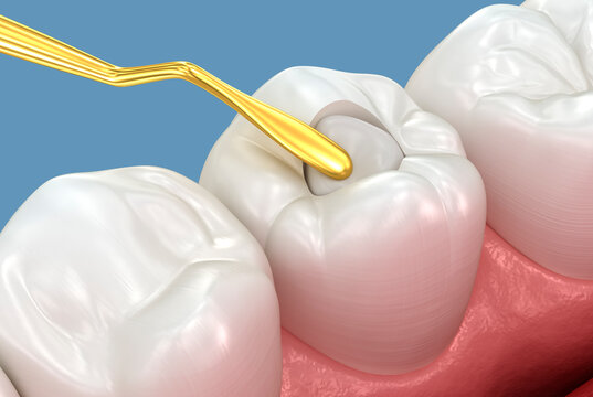 Toth restoration with filling. Tooth 3D illustration.