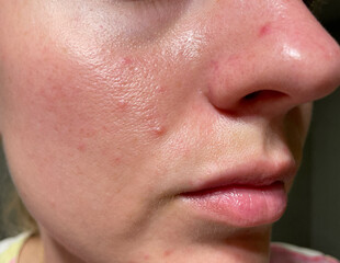Macro image of female face showing realistic skin texture, redness, visible pores, and mild acne....