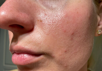 Macro photo of woman’s face with visible pores, acne, and skin redness on cheek and nose....