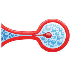 Atherosclerosis Disease Affecting Blood Flow in the Artery