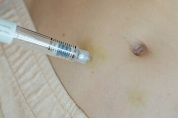 Female Hand Holding a Syringe Administering Medication to the Abdomen, Demonstrating Self-Injection...