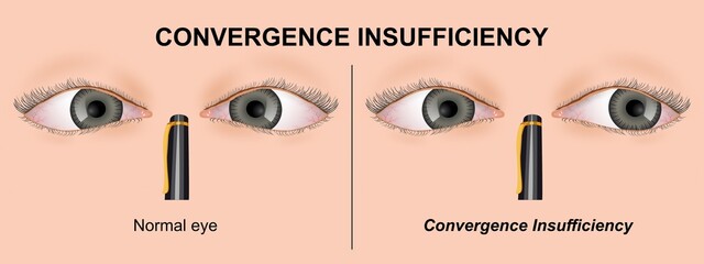 Convergence Insufficiency binocular vision system