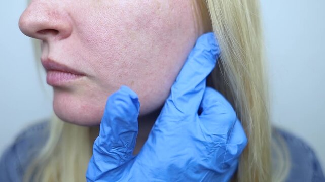 A dermatologist examines a woman face with dilated pores, pigmentation, and sebaceous filaments. Treatment of rosacea and skin inflammation.