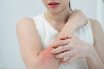 skin problem and beauty. Young woman scratch body has itchy skin from skin allergic, steroid...
