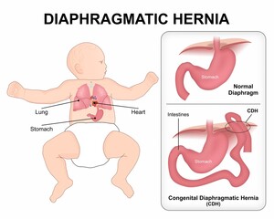 Congenital Diaphragmatic Hernia (CDH)