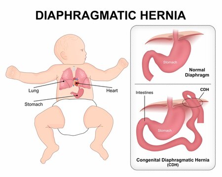 Congenital Diaphragmatic Hernia (CDH)