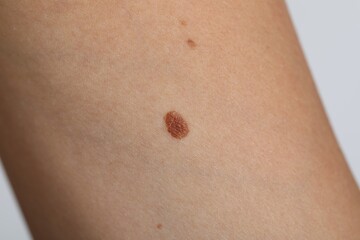 Woman with moles on her body against light grey background, closeup