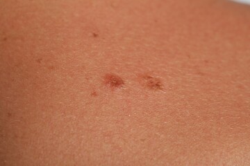 Woman with moles on her body, closeup