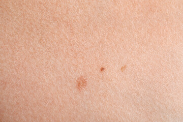 Woman with moles on her body, closeup