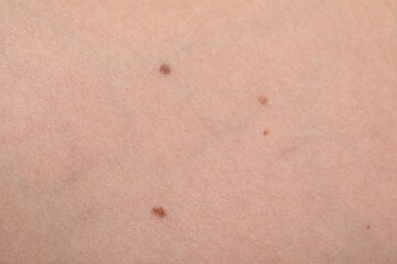 Woman with moles on her body, closeup