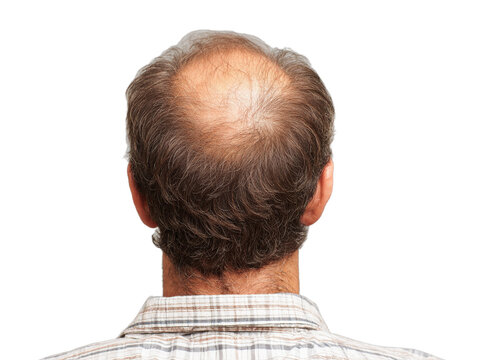 Hair loss solutions for men treatment options and prevention of male pattern baldness and thinning hair 100