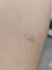 Fototapeta premium Close-up of small scars on human skin, bumpy and itchy skin, allergies, showing natural texture and healing process