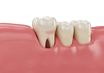 Isolated Impacted Wisdom Tooth in Gum 3D Render